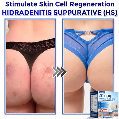🎉👑Celsiora® Multi-Functional Microneedle Hydrocolloid Patch Roll | Targets Skin Tags, Warts & Stubborn Blemishes