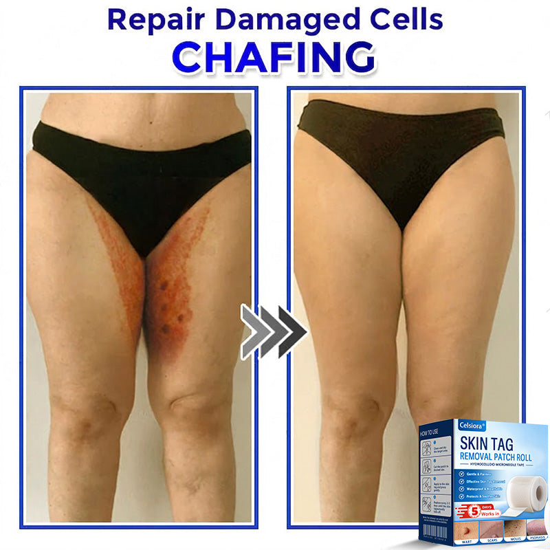 🎉👑Celsiora® Multi-Functional Microneedle Hydrocolloid Patch Roll | Targets Skin Tags, Warts & Stubborn Blemishes