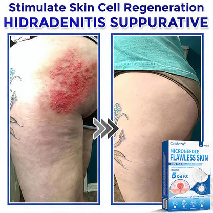 👨‍⚕️🎁Celsiora® 2-in-1 Microneedle & Hydrocolloid Patch | Raised Moles,Acne, Flat Warts & Skin Tags Remover | Improves Wrinkles, Scars & Blemishes | Invisible Pimple Patches for Face & Body | 24 Count