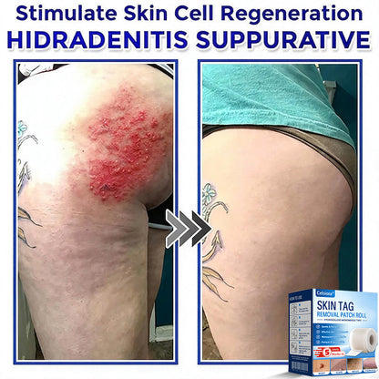 🎉👑Celsiora® Multi-Functional Microneedle Hydrocolloid Patch Roll | Targets Skin Tags, Warts & Stubborn Blemishes