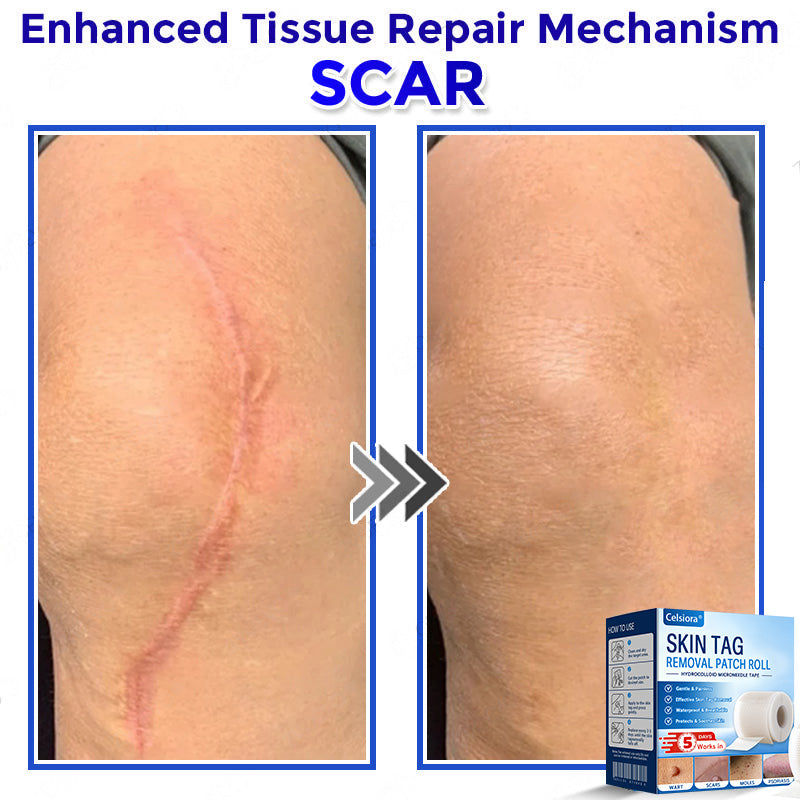 🎉👑Celsiora® Multi-Functional Microneedle Hydrocolloid Patch Roll | Targets Skin Tags, Warts & Stubborn Blemishes