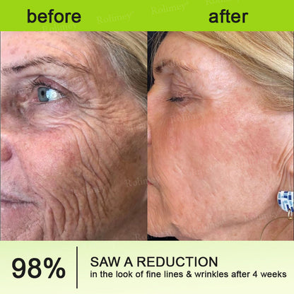 👨‍⚕️👨‍⚕️Made and shipped from the USA 💫Rolimey® Botox & Vita-A Retinol Shot Wrinkle-Lift Tightening cream - Last Day Promotion 50% OFF