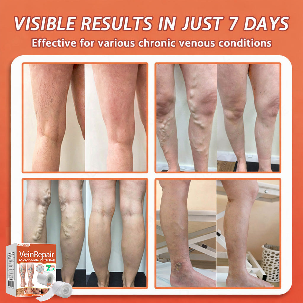 🧚Celsiora® Vein Ease Microneedle Care Patch - Last Day Promotion 50% OFF