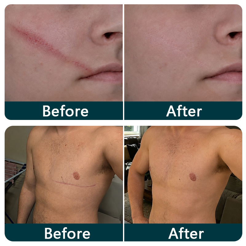 👩‍⚕️👩‍⚕️Trilumia® Silicone Scar Therapy Roll — Custom-Fit Care for Long, Raised Surgical Scars