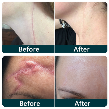 👩‍⚕️👩‍⚕️Trilumia® Silicone Scar Therapy Roll — Custom-Fit Care for Long, Raised Surgical Scars