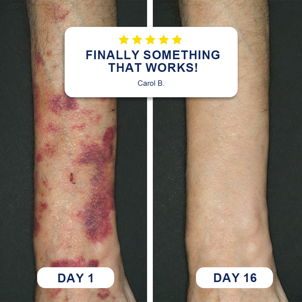 🌿🌿Evolvion® Bruise Care Balm-Advanced daily care for bruise-prone skin