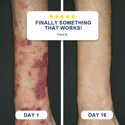🌿🌿Evolvion® Bruise Care Balm-Advanced daily care for bruise-prone skin