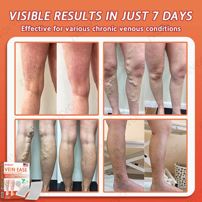🌿🌟Zvoevo® Vein Ease Microneedle Care Patch(For Spider Veins, Varicose Veins, Swelling & Leg Fatigue) - Last Day Promotion 50% OFF