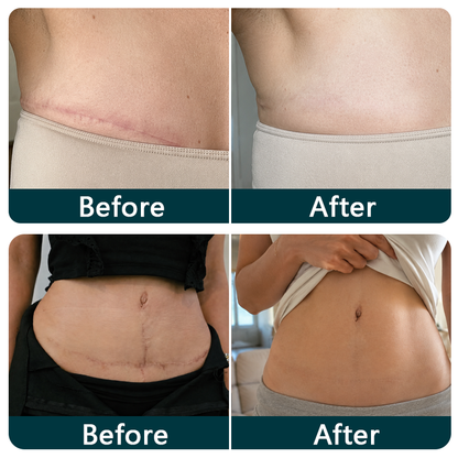 👩‍⚕️👩‍⚕️Trilumia® Silicone Scar Therapy Roll — Custom-Fit Care for Long, Raised Surgical Scars
