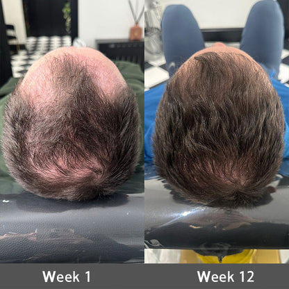 👩‍⚕️👩‍⚕️ Official US Store 🇺🇸 | 🔥Rolimey® Highly Effective Biotin & Rosemary Hair Growth Serum — (🔥 Limited-Time Offer, ⏳ Last Day Promotion 50% OFF)
