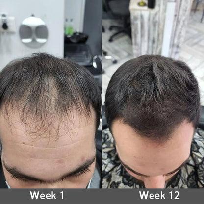 👩‍⚕️👩‍⚕️ Official US Store 🇺🇸 | 🔥Rolimey® Highly Effective Biotin & Rosemary Hair Growth Serum — (🔥 Limited-Time Offer, ⏳ Last Day Promotion 50% OFF)