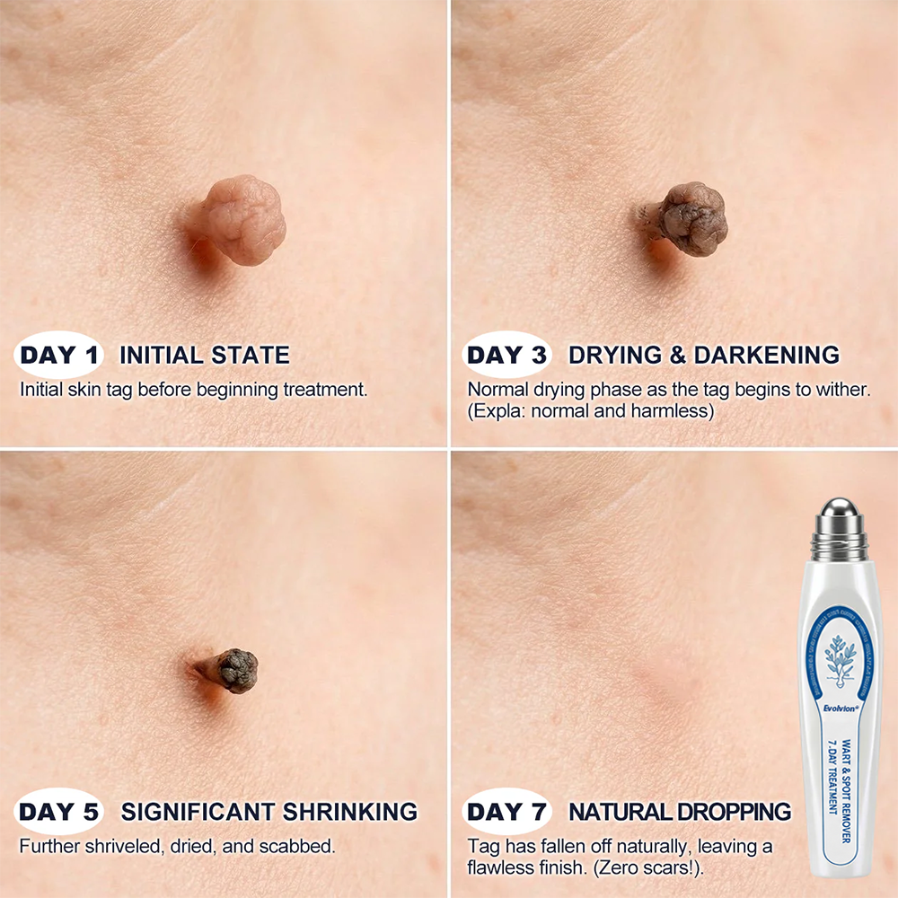 🌿✨Evolvion® 7-Day Skin Tag & Spot Eraser Painless & Scar-Free Advanced Imperfection Remova𝗜 Ro𝗜𝗜erba𝗜𝗜 Pen 🌵 🌵
