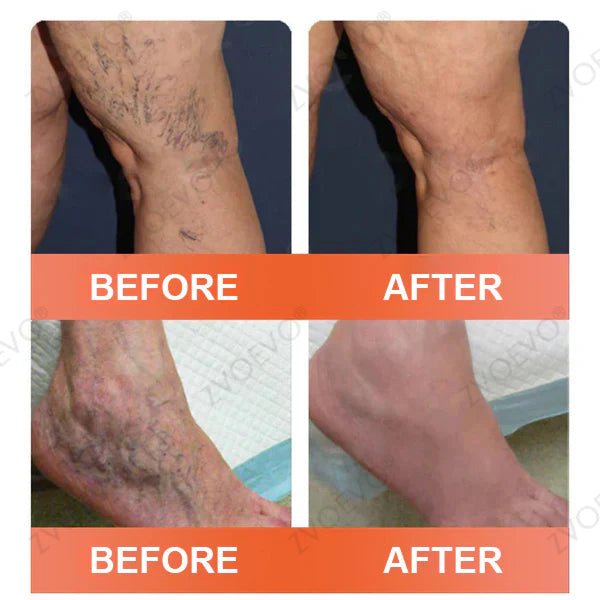 🌿🥇Celsiora® Vein Ease Microneedle Care Patch(For Spider Veins, Varicose Veins, Swelling & Leg Fatigue) - Last Day Promotion 50% OFF