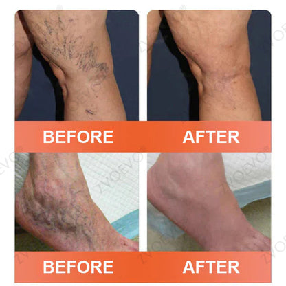🌿🥇Celsiora® Vein Ease Microneedle Care Patch(For Spider Veins, Varicose Veins, Swelling & Leg Fatigue) - Last Day Promotion 50% OFF