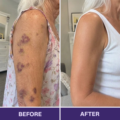👩‍⚕️Evolvion® Bruise Repair & Skin-Strengthening Cream-Advanced daily care for bruise-prone skin