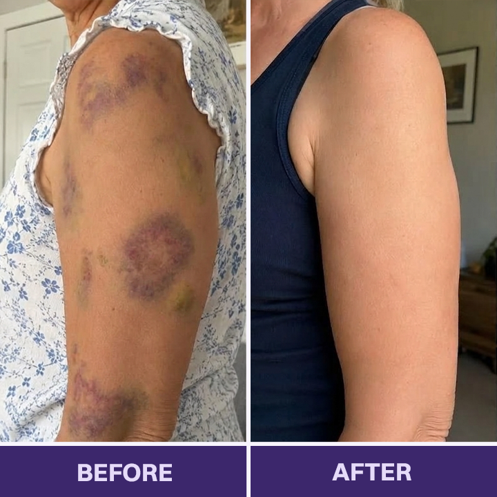 👩‍⚕️Evolvion® Bruise Repair & Skin-Strengthening Cream-Advanced daily care for bruise-prone skin