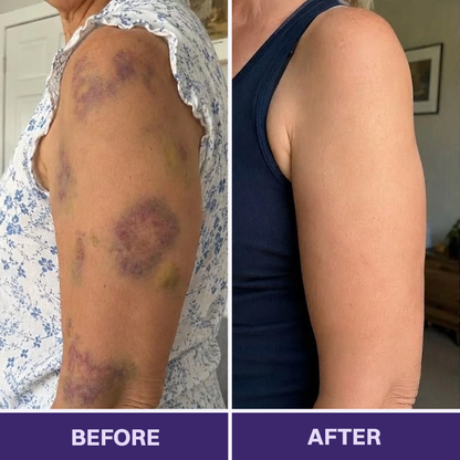 👩‍⚕️Evolvion® Bruise Repair & Skin-Strengthening Cream-Advanced daily care for bruise-prone skin