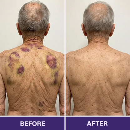 👩‍⚕️Evolvion® Bruise Repair & Skin-Strengthening Cream-Advanced daily care for bruise-prone skin