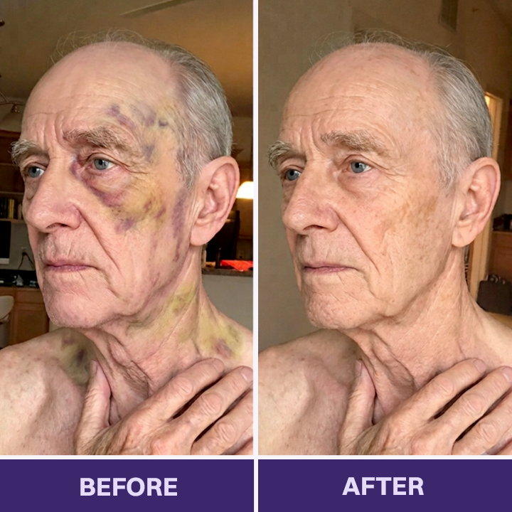 👩‍⚕️Evolvion® Bruise Repair & Skin-Strengthening Cream-Advanced daily care for bruise-prone skin