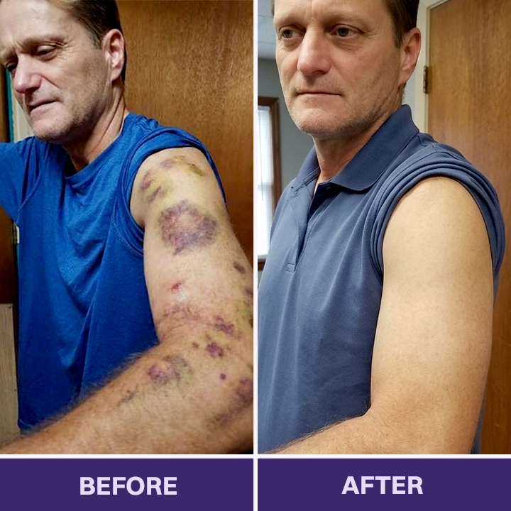 👩‍⚕️Evolvion® Bruise Repair & Skin-Strengthening Cream-Advanced daily care for bruise-prone skin