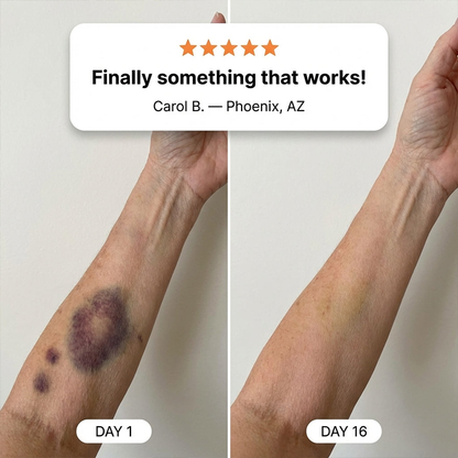 👩‍⚕️Evolvion® Bruise Repair & Skin-Strengthening Cream-Advanced daily care for bruise-prone skin