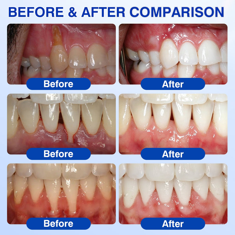 🇺🇸 👨‍⚕️🦷 Evolvion® GumCare Pro Advanced Gum Care Gel