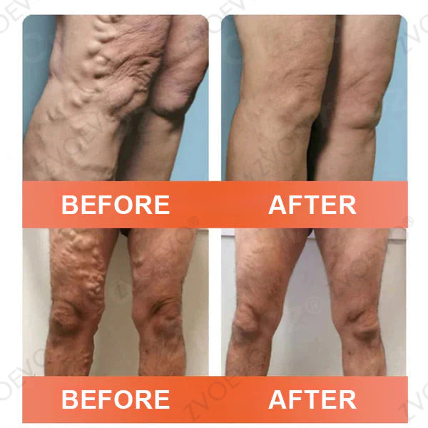 🌿🌟Zvoevo® Vein Ease Microneedle Care Patch(For Spider Veins, Varicose Veins, Swelling & Leg Fatigue) - Last Day Promotion 50% OFF